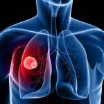 Lung cancer is the number one cause of cancer deaths globally